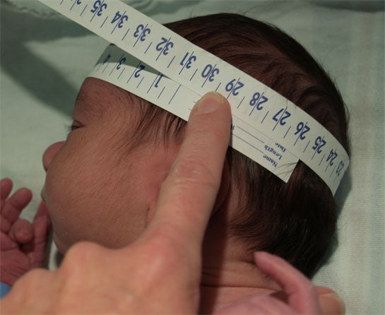 microcephaly- head circumference 30.5 cm Janelle Aby, MD Stanford.jpg